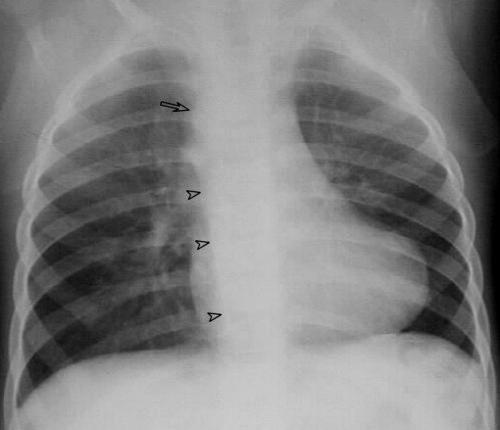 Tetralogy of Fallot Diagnosi ECG: right ventricular