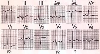 obstruction) Concavity of the left heart border