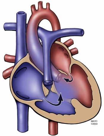 Tetralogy of Fallot Percutaneous correction