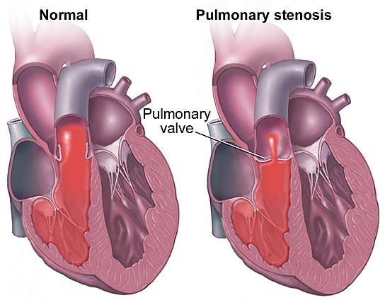 Stenosi valvolare polmonare Fisiopatologia Le