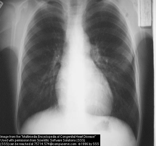 Stenosi valvolare polmonare Diagnosi Indagini di ausilio nella diagnosi possono essere: Rx Torace:
