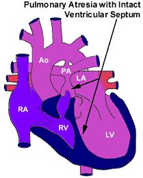 Atresia polmonare a setto intatto Anatomia Malformazione cardiaca nella