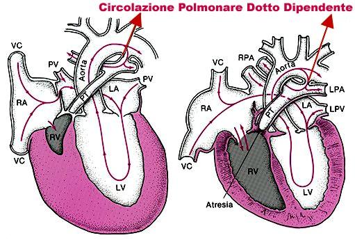 Atresia polmonare a setto intatto Fisiopatologia DI Dotto: DIA: