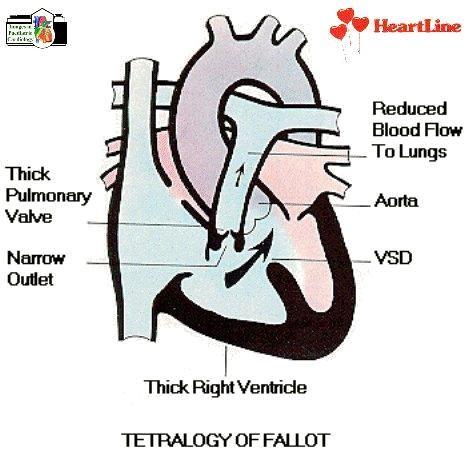 Tetralogy of Fallot Anatomia Deviazione anterosuperiore del setto infundibulare DIV aortic