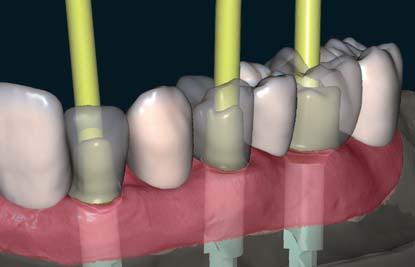 MODULO SOFTWARE CAD/CAM ABUTMENT - - Creazione degli abutment in relazione alla struttura secondaria - - - Supporta un ampio numero di sistemi implantari da avvitare