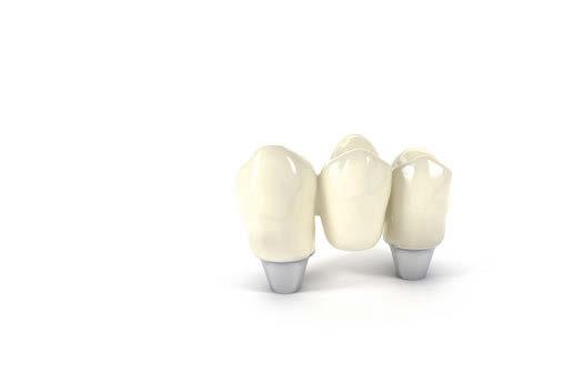 CARES X-STREAM PER PONTI E BARRE Straumann amplia la sua offerta CARES X-Stream efficiente ed economica proponendo restauri di denti multipli su impianti con ponti e overdenture.