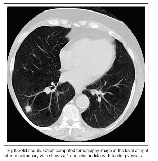 Possibili diagnosi radiologiche di un nodulo polmonare unico (spesso reperto occasionale in paziente asintomatico) evidenziato con la TAC Tumore benigno del polmone Tumore maligno del polmone