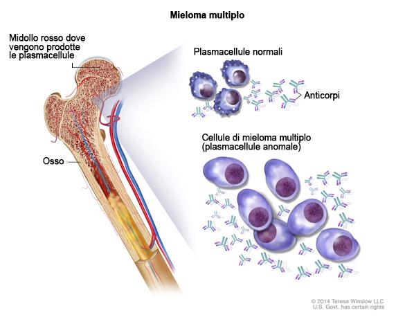 DEFINIZIONE DI MIELOMA MULTIPLO Il mieloma multiplo è un tumore maligno delle plasmacellule*, un tipo di globuli bianchi che si annidano nel midollo osseo.