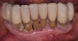dento-parodontale o periimplantare: parodontopatia cronica,
