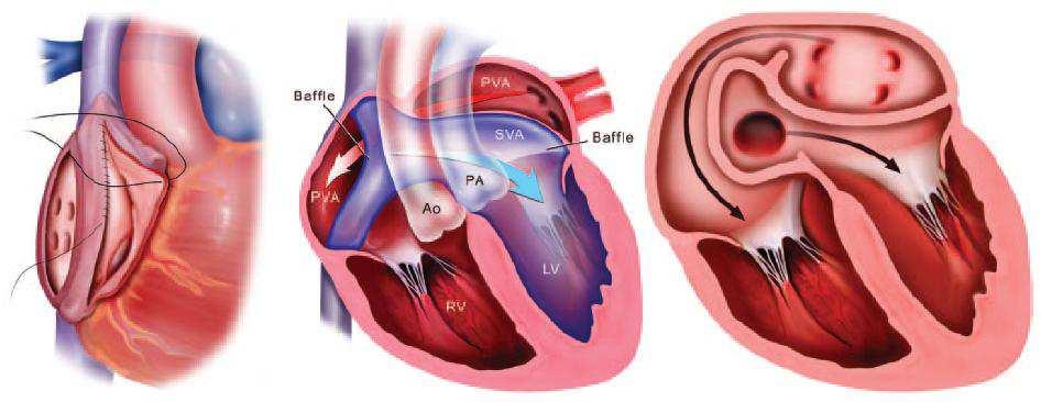 Background Nei pazienti affetti da trasposizione congenitamente corretta delle grandi arterie (cctga) e da trasposizione completa delle grandi arterie (TGA) dopo intervento di switch atriale