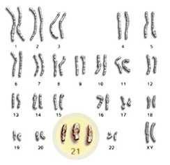 Eziologia Aneuplodie 8 10% Anomalie di un