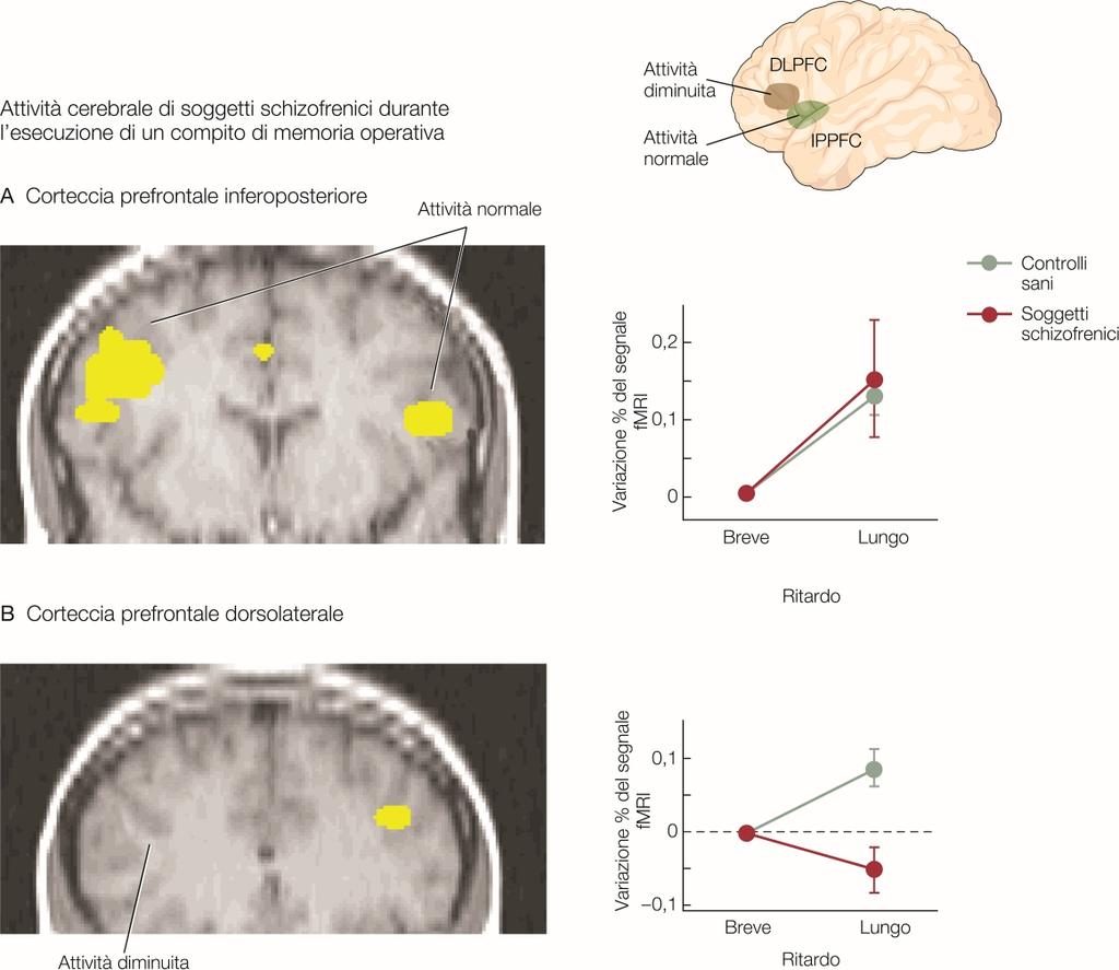 Schizofrenia Deficit funzionali della corteccia prefrontale nella schizofrenia Le aree inferoposteriori della corteccia prefrontale