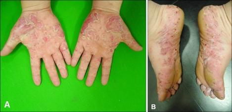 Psoriasi da Anti-TNF-α Precursori Cellule Dendritiche Plasmacitoidi TNF-α