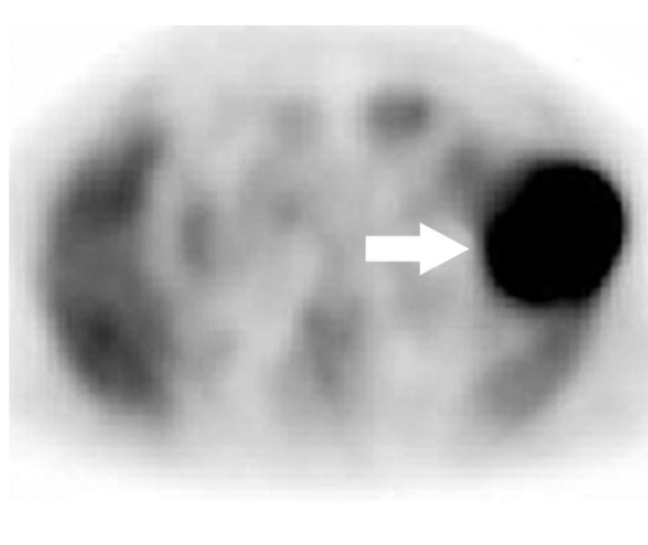 inizio del trattamento, mostra un tumore di dimensioni maggiori a confronto della TAC fatta due mesi prima.