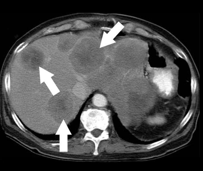 Immagine B: due mesi dopo l inizio della terapia con Glivec, la TAC mostra le lesioni omogenee con una diminuzione nella attenuazione, ma non c è sostanziale diminuzione nella dimensione del tumore.