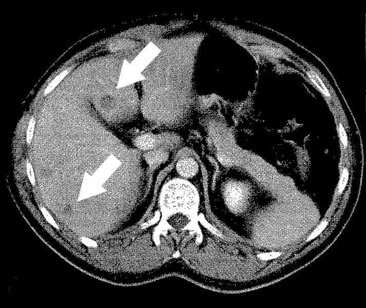 Immagine A: piccole metastasi all intestino, indicate con le