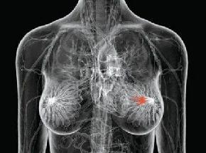 Mammografia Risonanza magnetica mammaria Linfonodi (parametro N): Visita senologica Ecografia