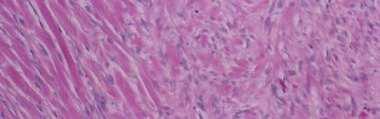 Tumore Desmoide (Fibromatosi Aggressiva AF) Dg: RM, TC, Biopsia, IIC (actina, B-catenina)