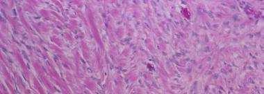 Nucleo/Citoplasma normale; Basso indice mitotico; AF extra-intestinali: Sarcoma