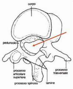 STENOSI LOMBARE Definizione Con il termine "stenosi lombare" (dal greco stenosis: restringimento) si intende una diminuzione del diametro del canale vertebrale, del recesso laterale e/o dei forami