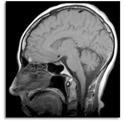 neurodegenerative.. Diagnosi precoce di tumori o metastasi cerebrali, di ernie del disco della colonna vertebrale.
