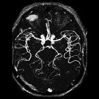 angiografia RMN 7 L'angiografia RM consente di visualizzare i grossi tronchi arteriosi e venosi etra- e intracerebrali senza la necessità di un mezzo di contrasto ai raggi X.