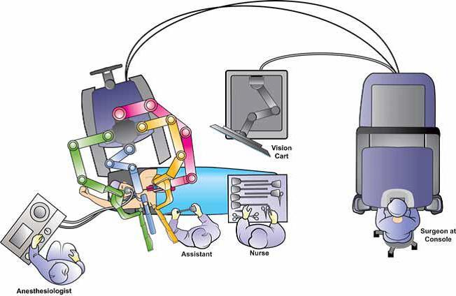 2. Docking del robot; 3. Console-time; 4. Chiusura. L equipe chirurgica si posizione come mostrato nella Fig.1.