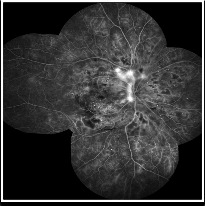 Retinopatia proliferante Neovascolarizzazioni retiniche e discali, emorragie preretiniche e vitreali