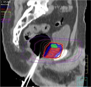 Local Protocol Variations for Image Guided Radiation Therapy in the Multicenter Dutch Hypofractionation (HYPRO) Trial: Impact of Rectal Balloon and MRI Delineation on Anorectal Dose and