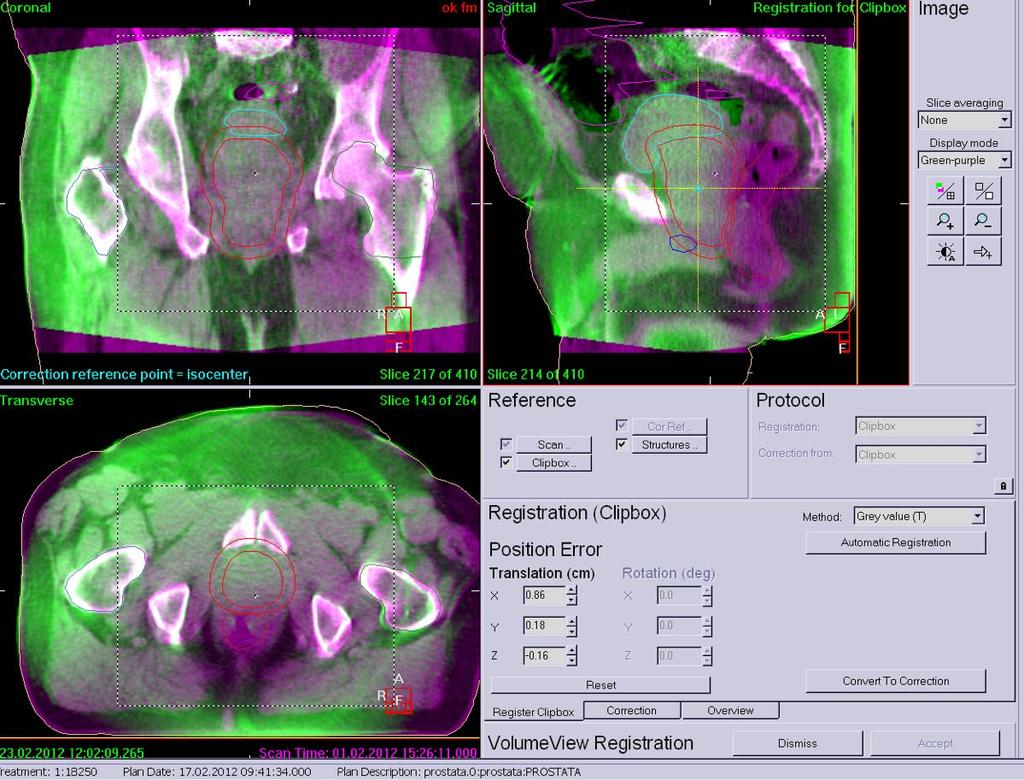 Cone Beam CT con acceleratore