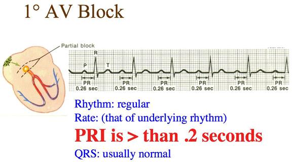 Blocco atrioventricolare di I grado (BAV I ) L intervallo PR misura il tempo di conduzione dell impulso elettrico tra gli atri e i ventricoli.