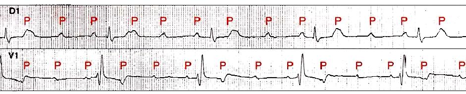 Aspetti ECG del BAV totale (2) I complessi QRS sono conseguenti all attività di scappamento ventricolare.