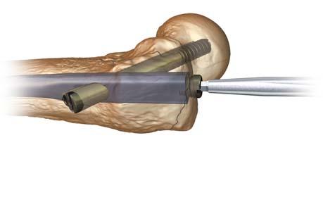 Inserimento del tappo Si consiglia l impianto del tappo per chiudere e mantenere libera l estremità prossimale del chiodo qualora si preveda crescita ossea all interno del chiodo.