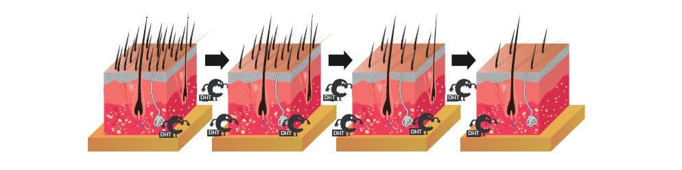 Quando il DHT si lega a recettori specifici presenti nel follicolo pilifero diventa causa di miniaturizzazione del follicolo con conseguente caduta del capello oltre ad un accorciamento della fase