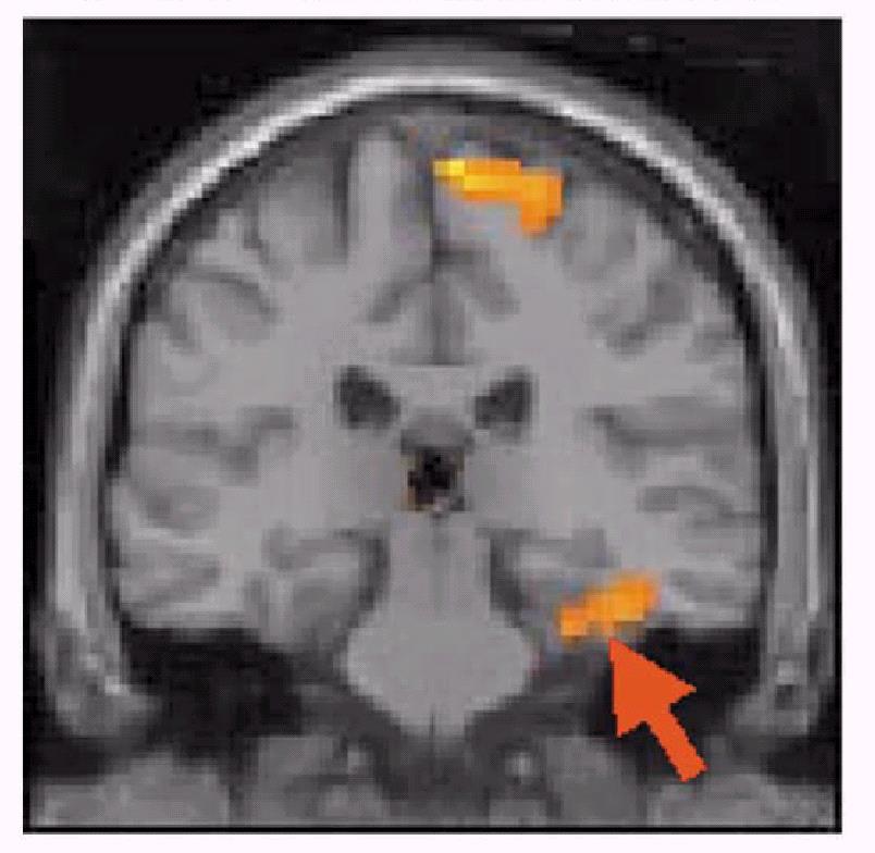 Risonanza Magnetica Funzionale effetti della terapia cognitivo-comportamentale in pazienti