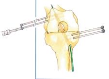 Spesso il punto di inserzione della cannula prossimale può apparire alto e in alcuni casi si può utilizzare il portale artroscopico antero mediale; nello strumentario è previsto un palpatore osseo