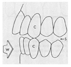 Figura 12B In un rapporto ideale di I Classe (W), nel lato di lavoro le cuspidi dei canini saranno punta a punta C - C, che creerà uno spazio tra il resto dei denti posteriori sul lato di lavoro S e