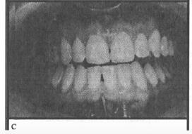 (Figura 13). Figura 13 La dentatura naturale sana di una paziente di circa 27 anni di età.