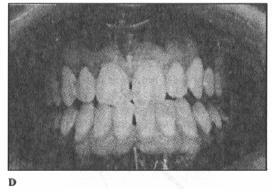 (A) La separazione dei denti posteriori è dovuto alle cuspidi dei denti canini.