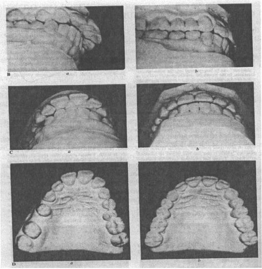 (B-C-D) (E) Figura 23 I modelli prima e dopo il trattamento di un paziente di sesso maschile di 42 anni che aveva avuto un intervento ortodontico pre-restaurativo allo scopo di ottenere una posizione