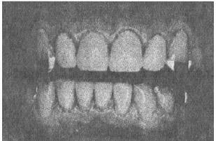 RIPRISTINO DEI DENTI GRAVEMENTE USURATI Alcuni autori ritengono che se un paziente ha consumato i denti gravemente, è perché i muscoli necessitano una libertà per effettuare i movimenti e che sarebbe