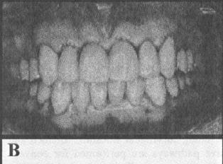 Il morso aperto anteriore è stato corretto unicamente con misure di restauro poiché la dimensione verticale dell'occlusione non poteva essere ridotta a causa del rapporto dei denti
