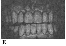 Il paziente era stato trattato senza successo con la terapia miofunzionale. Non era trattabile con ortodonzia. (A) mostra i denti in occlusione centrica.