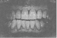 I pazienti con assetto dei denti come questo mostrano una minor quantità di usura sulla loro denti (F), e raramente o mai sviluppano disfunzione temporomandibolare congiunta a sindromi