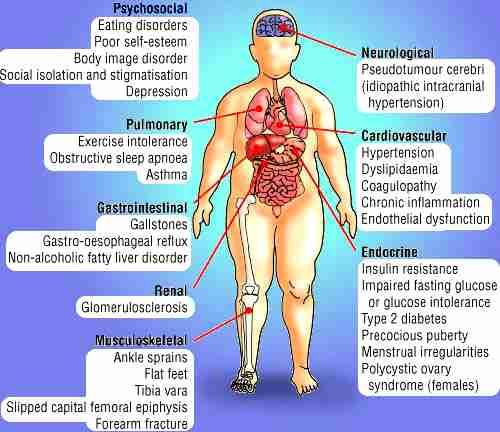 Complicanze dell obesità a esordio precoce PRINCIPALI COMPLICANZE S.