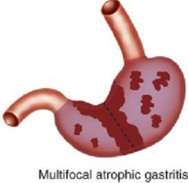 Gastrite Antrale Gastrite da HP (tipo B) Gastrite Atrofica Multifocale