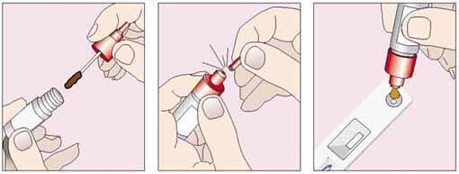 HpSA test (Atg Hp nelle feci) Helicobacter pylori stool antigen test NPV elevato dopo tx eradicante Esofagite Erosiva da