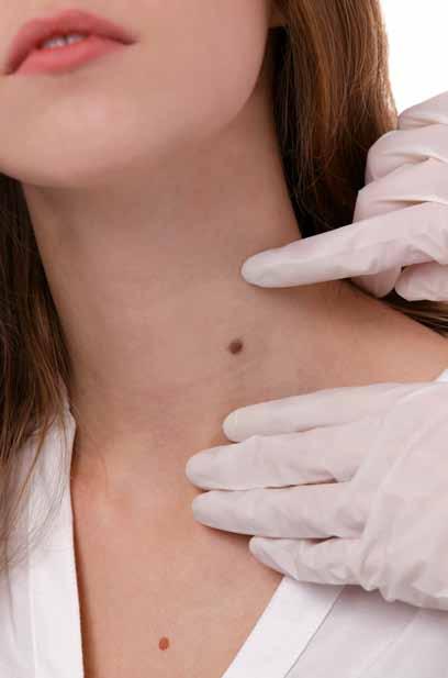 I tumori cutanei ed il melanoma vengono individuati per oltre il 60% dei casi da parte dello stesso soggetto e dal partner, familiari e amici, nel 18% da dermatologi, nel 15% da medici di medicina