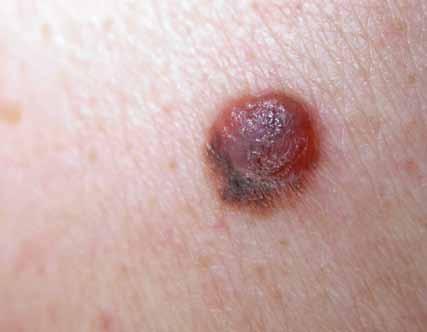 Le principali lesioni maligne cutanee sono: I TUMORI CUTANEI NON MELANOMA Sono al primo posto per frequenza, ma possono essere evitati con una corretta prevenzione e guarire in un altissima