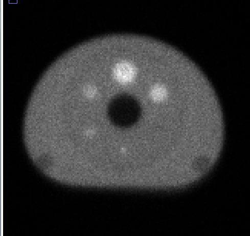 distanza gamma-camera 2 dal lettino H2 = 111 mm.